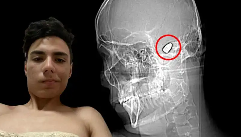 Kafasında Patlayıcı Bomba Taşıyan Adamın Sıra Dışı Hikayesi