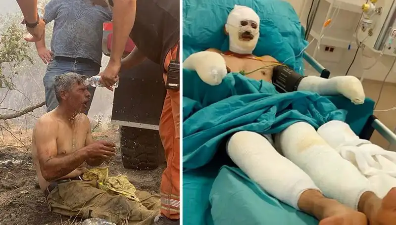 Yanıyorum Diyerek Feryat Eden Orman İşçisinin Hayati Mücadelesi Devam Ediyor